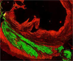 preoperative myocardial cell injury